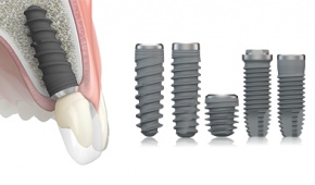 Dental Implants